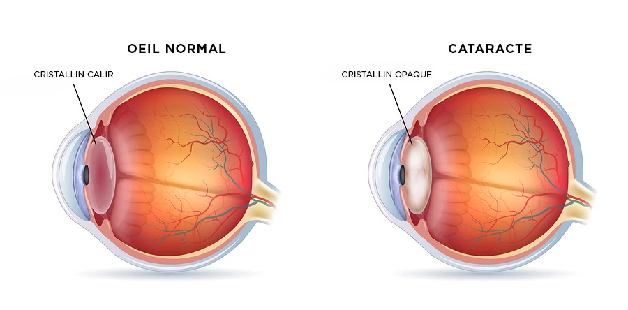 Comparaison entre un cristallin transparent et un cristallin opacifié par la cataracte