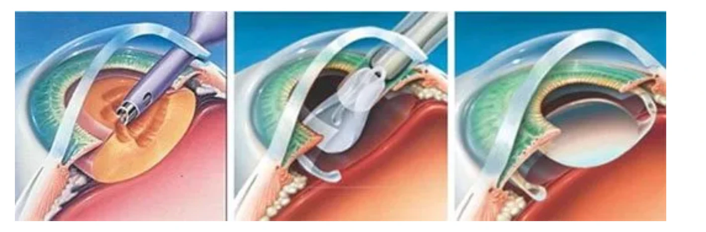 Étapes illustrées du remplacement du cristallin par un implant