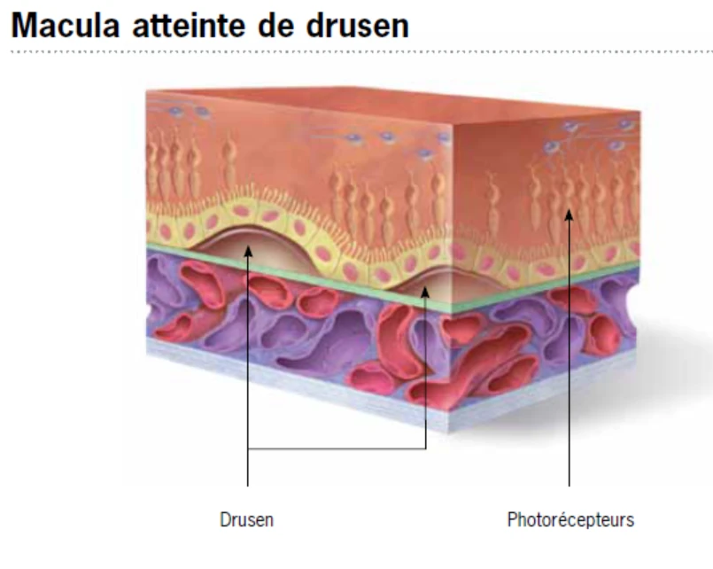 Schéma des dépôts appelés drusen sous la macula