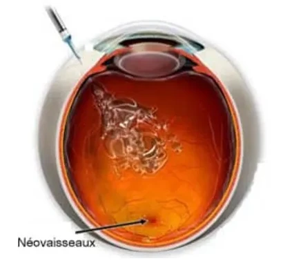 Schéma d’une injection intravitréenne dans l’œil