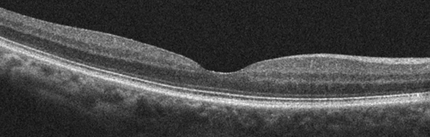 Coupe OCT de la rétine et de la macula